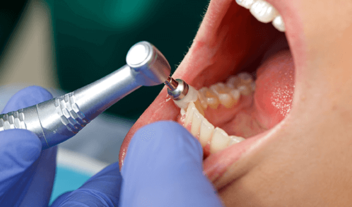 予防・クリーニング